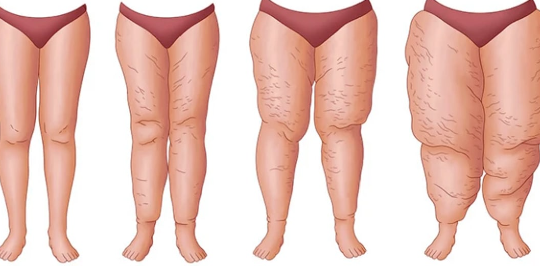 Medical Aesthetic Fettabsaugen Dr. Urs Benz